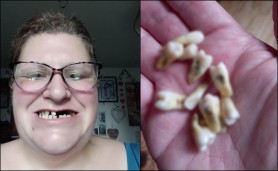 FOTO // O mamă şi-a scos singură 11 dinţi, pentru că nu avea bani să meargă la un dentist